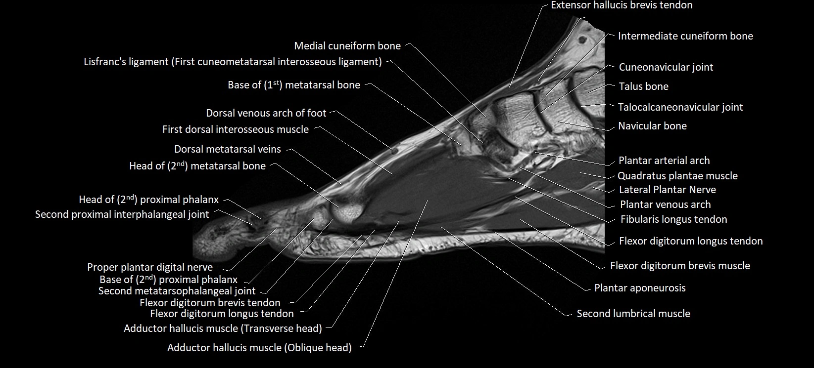 MRI foot sagittal labelled cross sectional anatomy image  11.webp